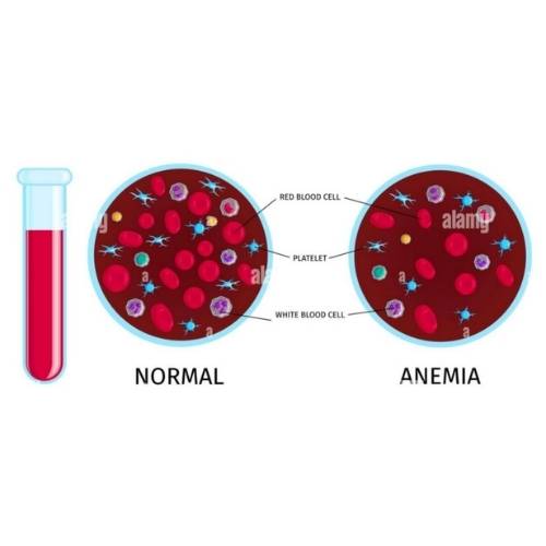 Get a Necessary Anemia Test | anemia, hemoglobin and more | Medasia ...