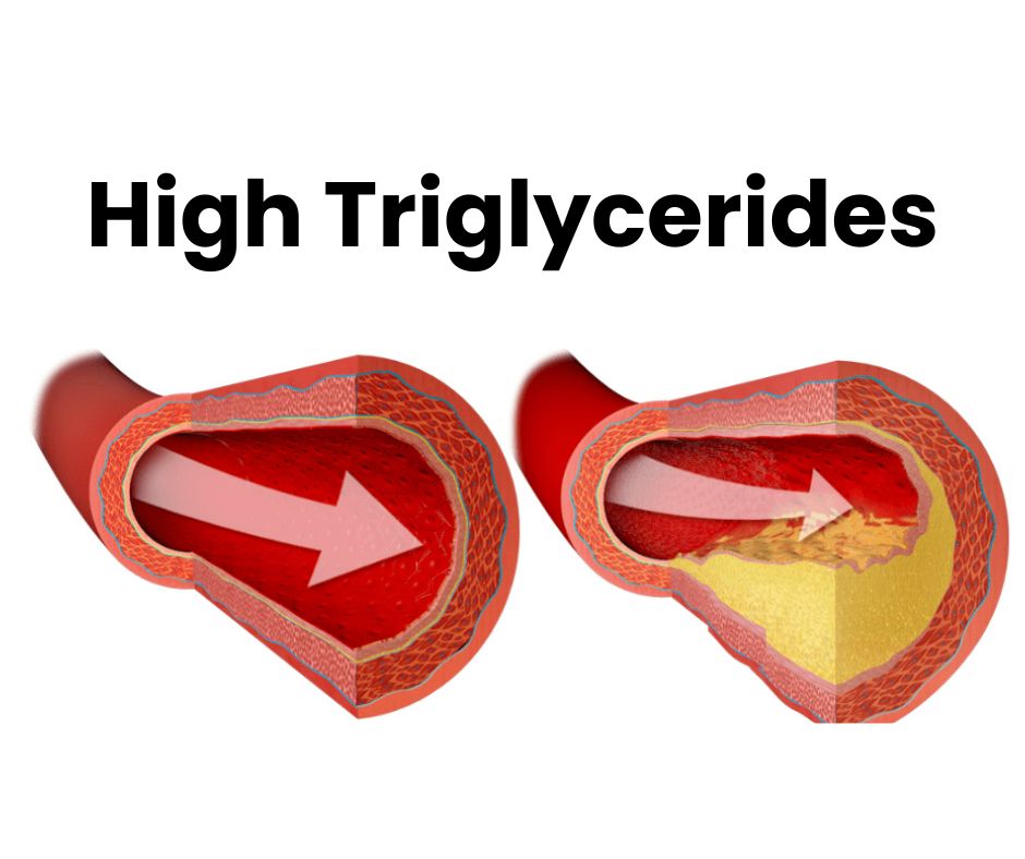 10-risks-and-7-tips-with-high-triglycerides-cholesterol-high